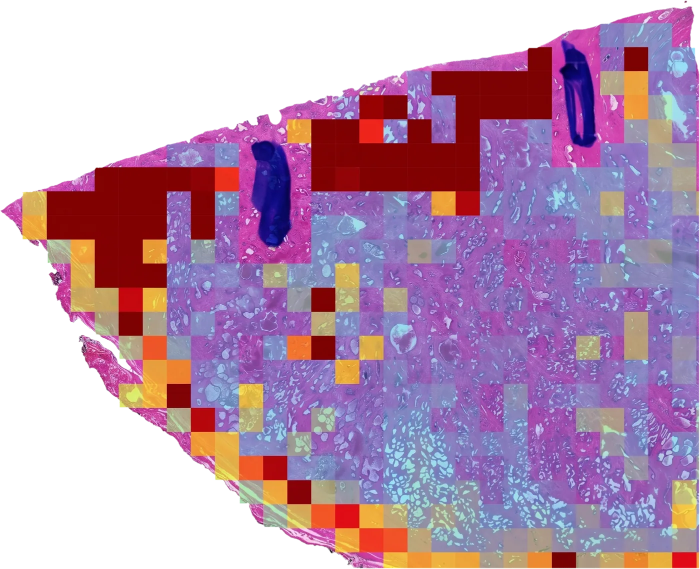 Prostatectomy slide with regions weighted by a recurrence-risk model; red marks high attention