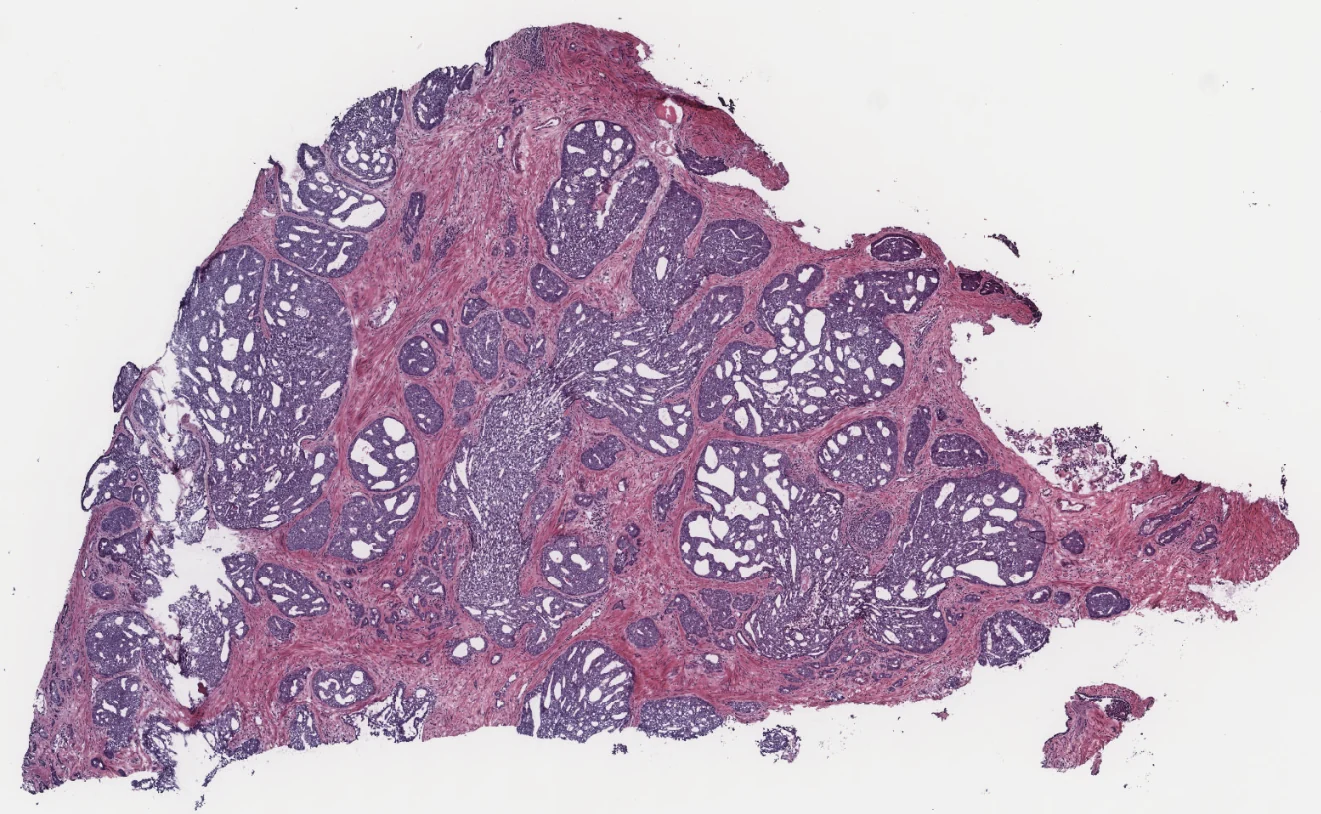Prostatectomy slide, H and E stained, shown as a pathologist sees it